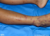 henoch-shönlein_purpura-iga_vasculite