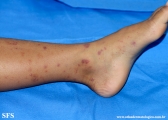 henoch-shönlein_purpura-iga_vasculite