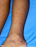 henoch-shönlein_purpura-iga_vasculite