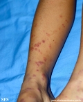 henoch-shönlein_purpura-iga_vasculite
