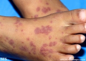 henoch-shönlein_purpura-iga_vasculite