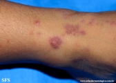 henoch-shönlein_purpura-iga_vasculite