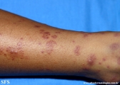 henoch-shönlein_purpura-iga_vasculite