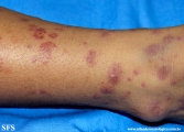 henoch-shönlein_purpura-iga_vasculite