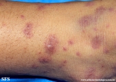 henoch-shönlein_purpura-iga_vasculite