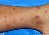 henoch-shönlein_purpura-iga_vasculite