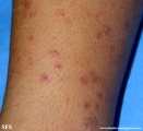 henoch-shönlein_purpura-iga_vasculite
