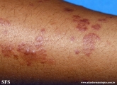 henoch-shönlein_purpura-iga_vasculite