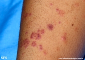 henoch-shönlein_purpura-iga_vasculite