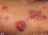 henoch-shönlein_purpura-iga_vasculite
