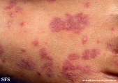 henoch-shönlein_purpura-iga_vasculite
