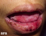 cicatricial pemphigoid