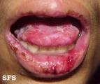 cicatricial pemphigoid