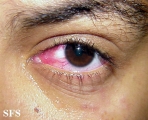 cicatricial pemphigoid