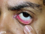 cicatricial pemphigoid