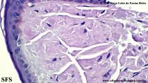 amyloidosis-nodular amyloidosis