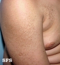 ichthyosis vulgaris