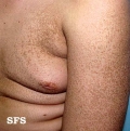 ichthyosis vulgaris