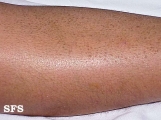 ichthyosis vulgaris