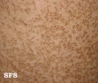 ichthyosis vulgaris