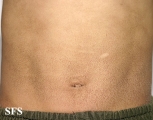ichthyosis vulgaris