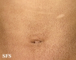 ichthyosis vulgaris