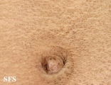 ichthyosis vulgaris