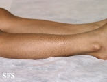 ichthyosis vulgaris