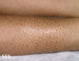 ichthyosis vulgaris