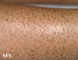ichthyosis vulgaris