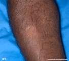 leprosy tuberculoid