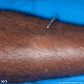 leprosy tuberculoid
