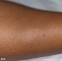leprosy tuberculoid