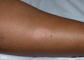 leprosy tuberculoid