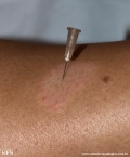 leprosy tuberculoid