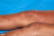 leprosy tuberculoid