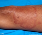 leprosy tuberculoid