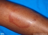 leprosy tuberculoid