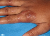 leprosy tuberculoid
