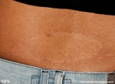 leprosy tuberculoid