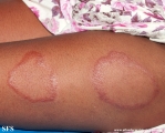 leprosy tuberculoid