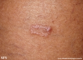 leprosy tuberculoid
