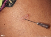 leprosy tuberculoid