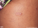 leprosy tuberculoid