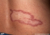 leprosy tuberculoid