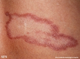 leprosy tuberculoid