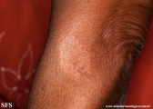 leprosy tuberculoid