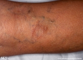 leprosy tuberculoid