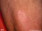 leprosy tuberculoid