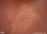 leprosy tuberculoid